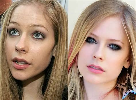 avril lavigne implants